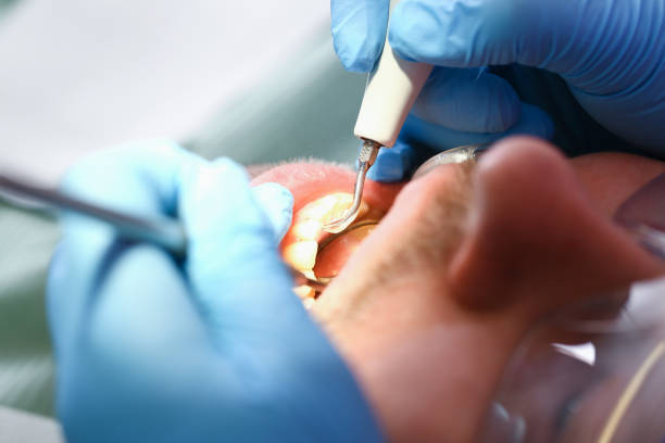 Best Emergency Dental Extractions in St Clair, MI